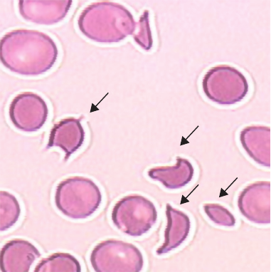 Schizocytes.