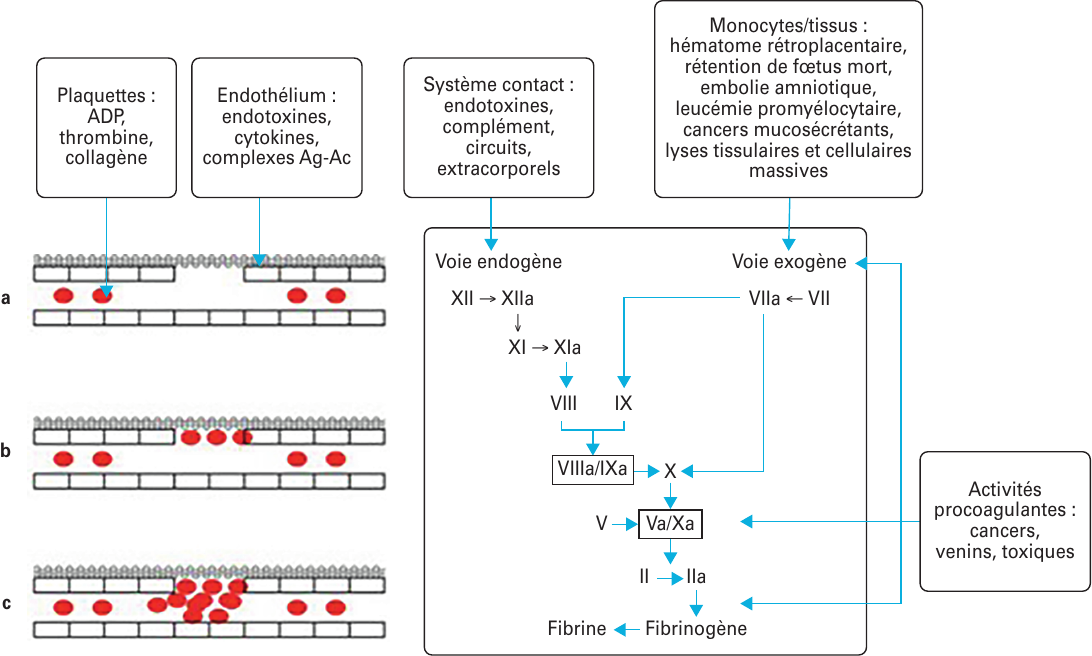 Modes d’activation d’une CIVD.