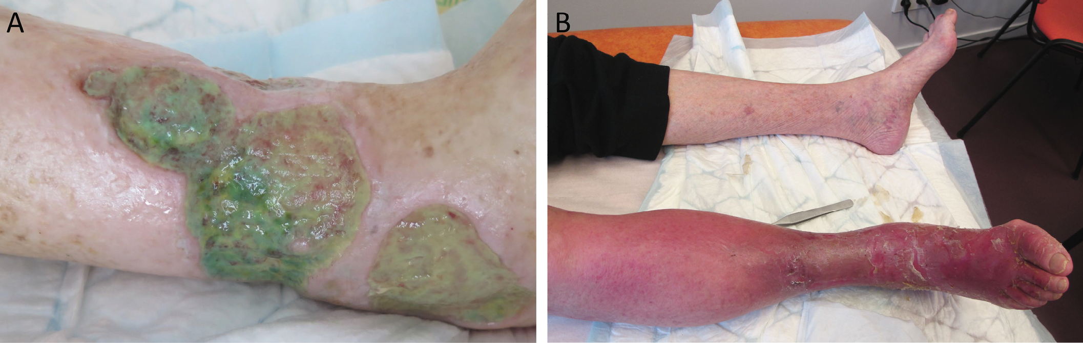 Figure 137 .10 : Aspects cliniques distincts de la colonisation à pyocyanique et de la dermo-hypodermite bactérienne.