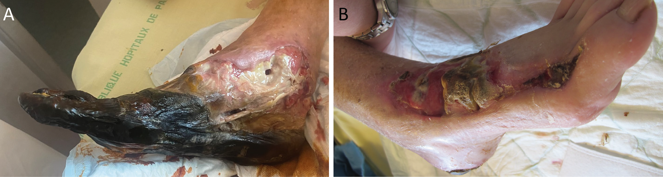 Figure 137 .11 : Ulcères artériels non re-vascularisables à des stades très évolués.