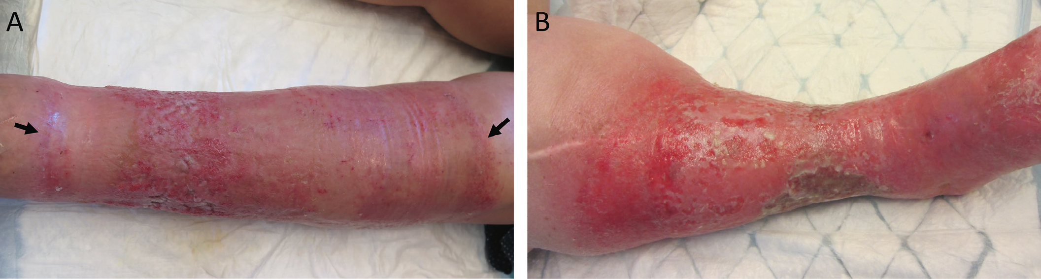 Figure 137 .12 : A. Eczéma de contact à un pansement super-absorbant de grande taille. Eruption érythémateuse vésiculeuse, prurigineuse, à bords inférieurs et supérieurs nettes (flèches), épousant la forme du pansement. B. Eczéma variqueux de forme suintante.