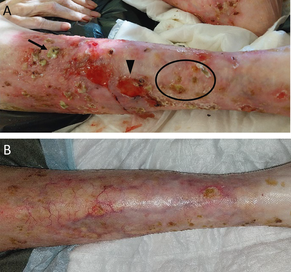 Figure 137 .13 : Dermatose érosive et pustuleuse de jambe.