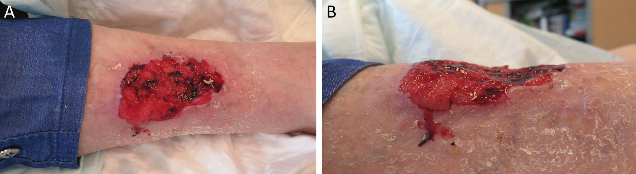 Figure 137 .7 : Carcinome se présentant sous la forme d’un UDJ. Lésion négligée, évoluant depuis plusieurs années chez une patiente âgée de 96 ans. Le caractère hyper-bourgeonnant (bien visible de profil) et spontanément hémorragique sont très suspects. La biopsie cutanée confirmait ici le diagnostic de carcinome épidermoïde.