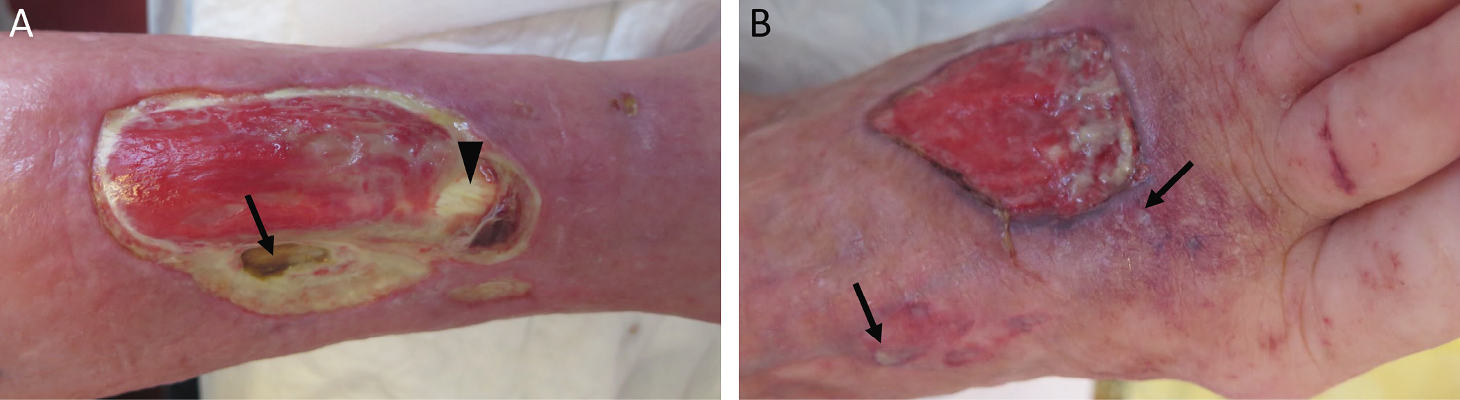 Figure 137 .8 : Ulcères tibial antérieur et du dos du pied sur pyoderma gangrenosumassocié à une polyarthrite rhumatoïde chez une patiente de 94 ans.